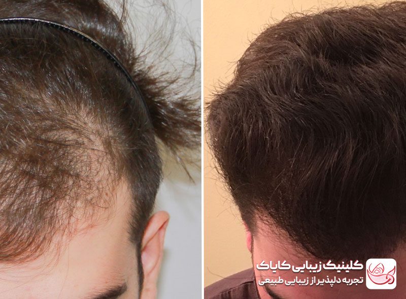 پی آر پی مو قبل و بعد