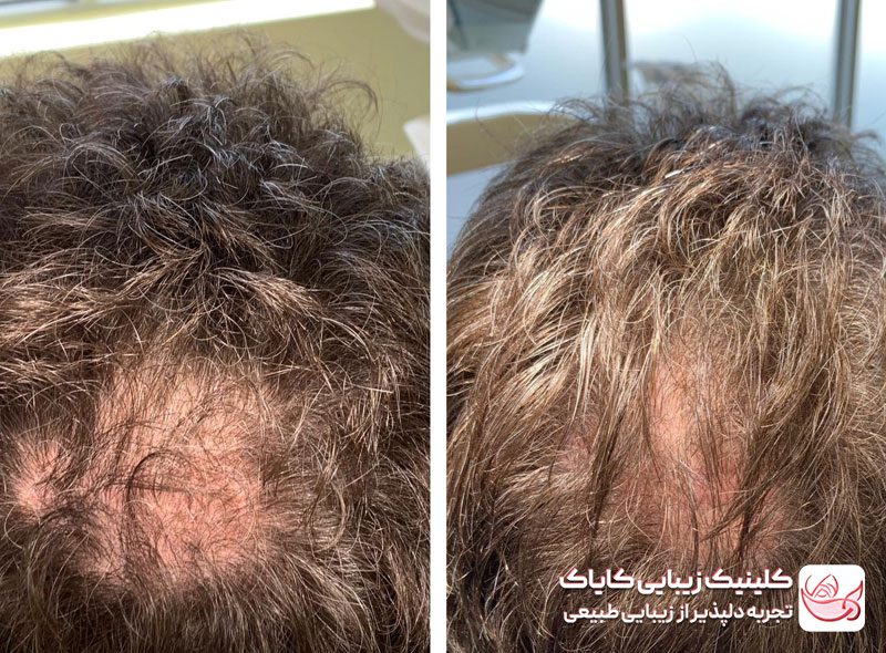 پی آر پی مو قبل و بعد