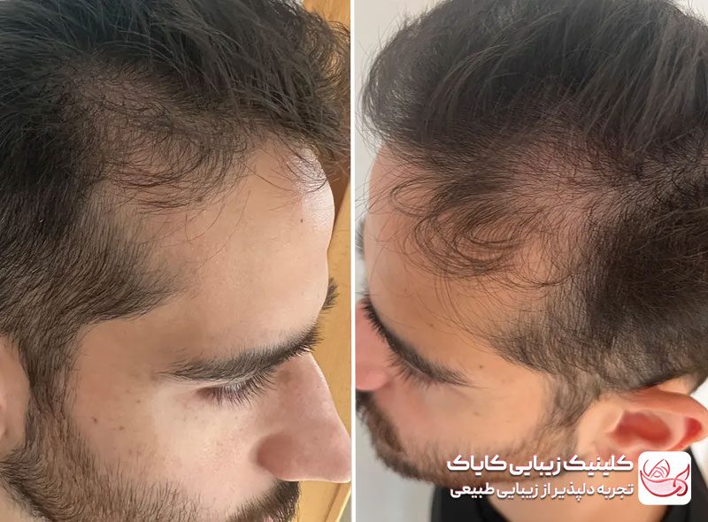 کاشت موی سر قبل و بعد