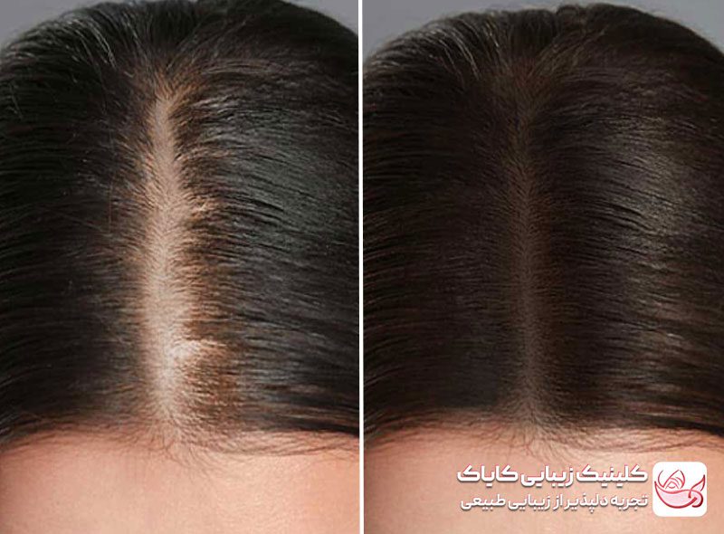 درمان ریزش مو