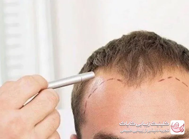 <span style="font-size: 25px; letter-spacing: -1.8px;">کاشت موی سر</span><span style="font-size: 25px; letter-spacing: -1.8px;"></span>