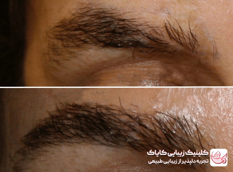 کاشت ابرو دائمی قبل و بعد