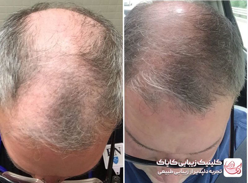 مزونیدلینگ سر قبل و بعد