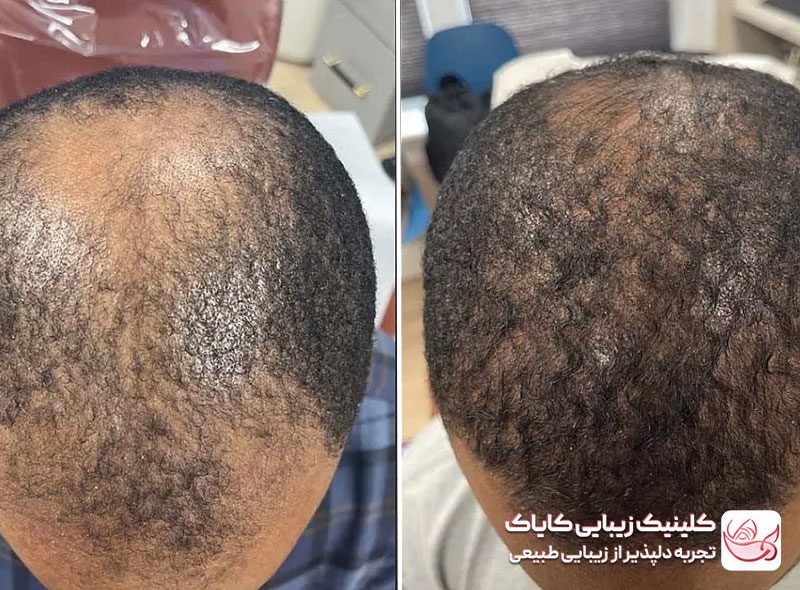 مزونیدلینگ مو قبل و بعد