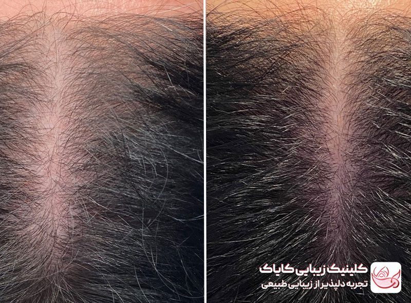 مزونیدلینگ سر قبل و بعد