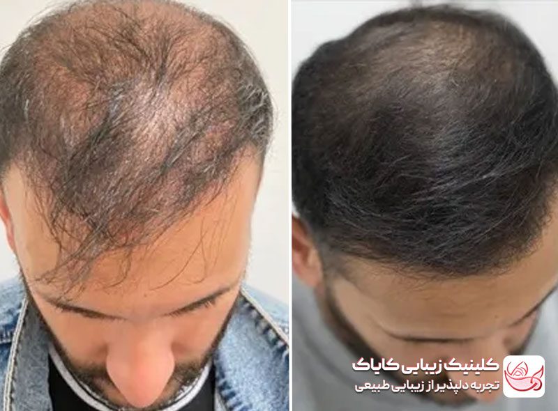 مزونیدلینگ سر قبل و بعد