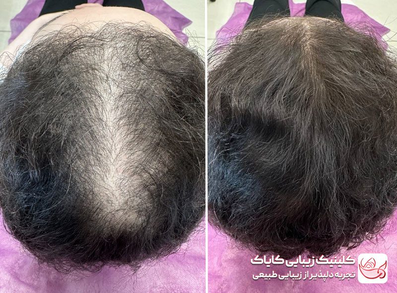 مزونیدلینگ سر قبل و بعد