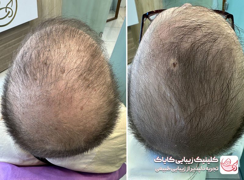 درمان ریزش موی سر قبل و بعد