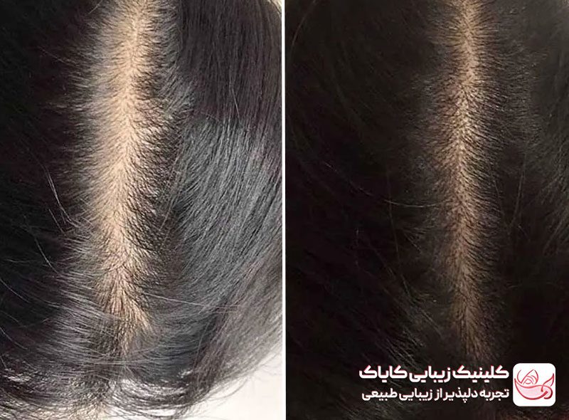 مزونیدلینگ سر قبل و بعد