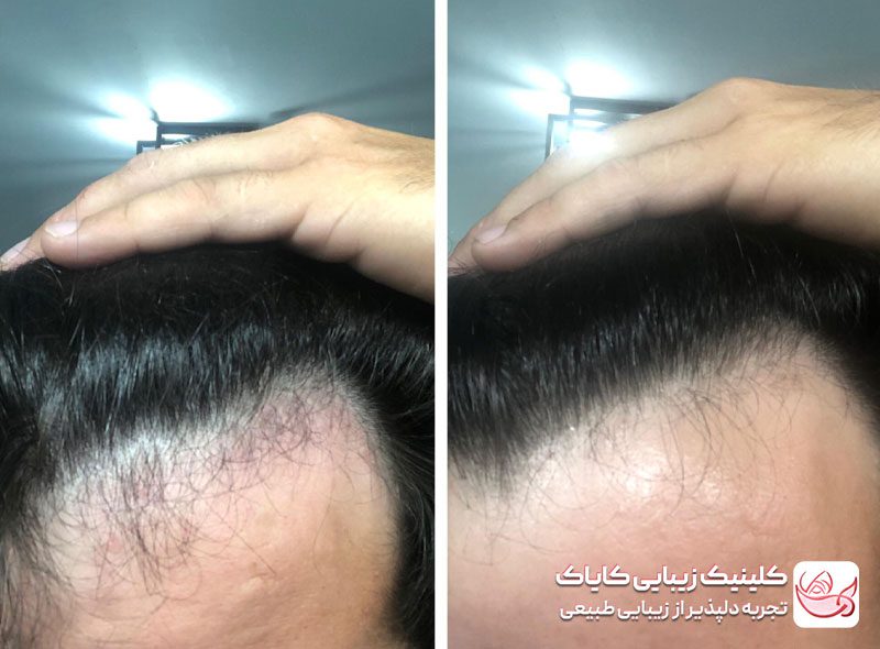 مزونیدلینگ سر قبل و بعد