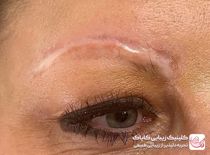 درمان ریزش ابرو بر اثر تتو یا مواد آرایشی