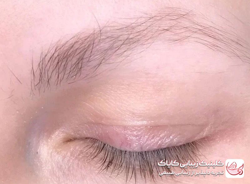 درمان کم‌پشتی و ریزش ژنتیکی ابروها