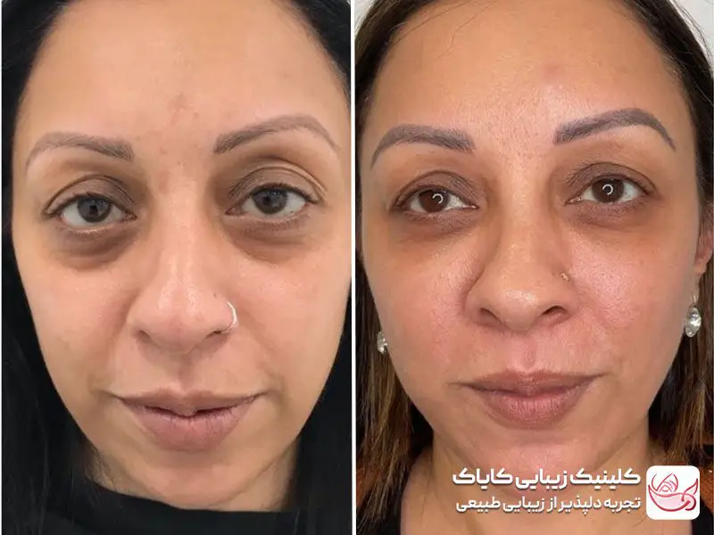 مادلینگ صورت