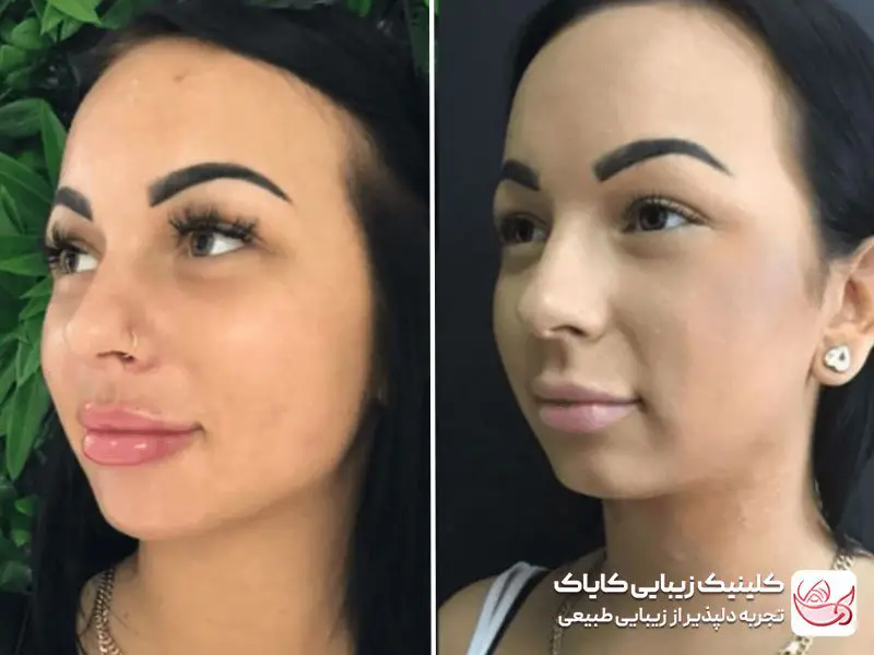 فیلر خط لبخند