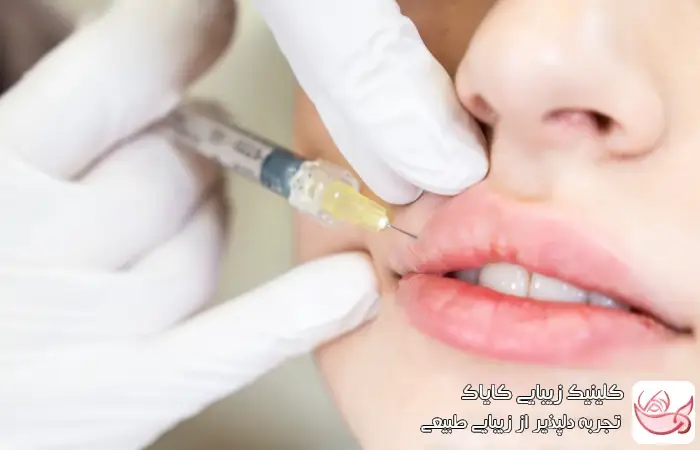 فیلر لب و نقش آن در اصلاح لبخند لثه‌ای