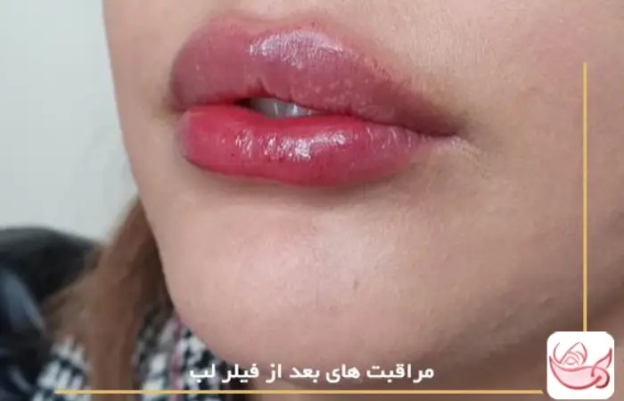 مراقبت های بعد از فیلر لب