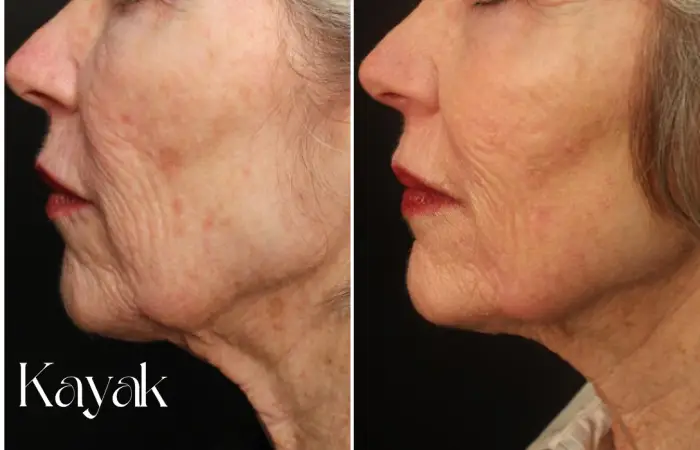 RF Microneedling