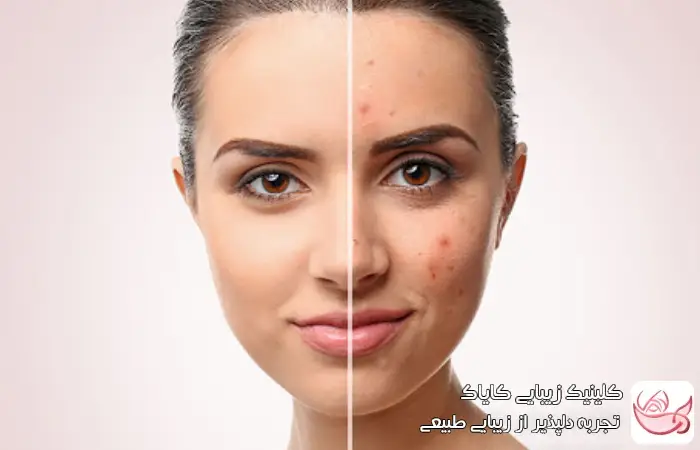 جوش هورمونی