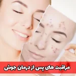 بعد از درمان جوش چه مراقبت هایی لازم است؟