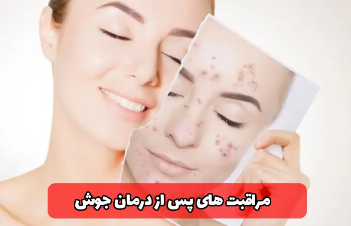 مراقبت های بعد از درمان جوش