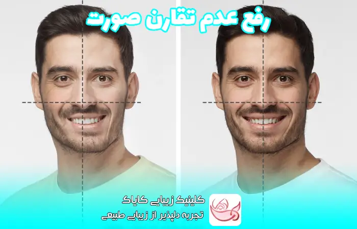 رفع عدم تقارن صورت