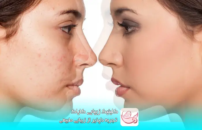 راکوتان
