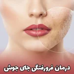 برای درمان فرورفتگی جای جوش میکرونیدلینگ بهتر است یا لیزر؟