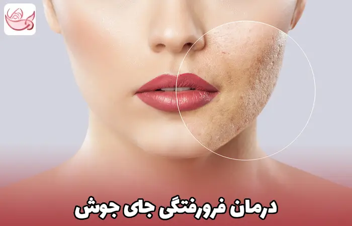 درمان فرورفتگی جای جوش
