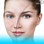 قبل از شروع درمان جوش صورت چه آزمایش هایی لازم است؟