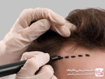 hair-transplant کاشت مو